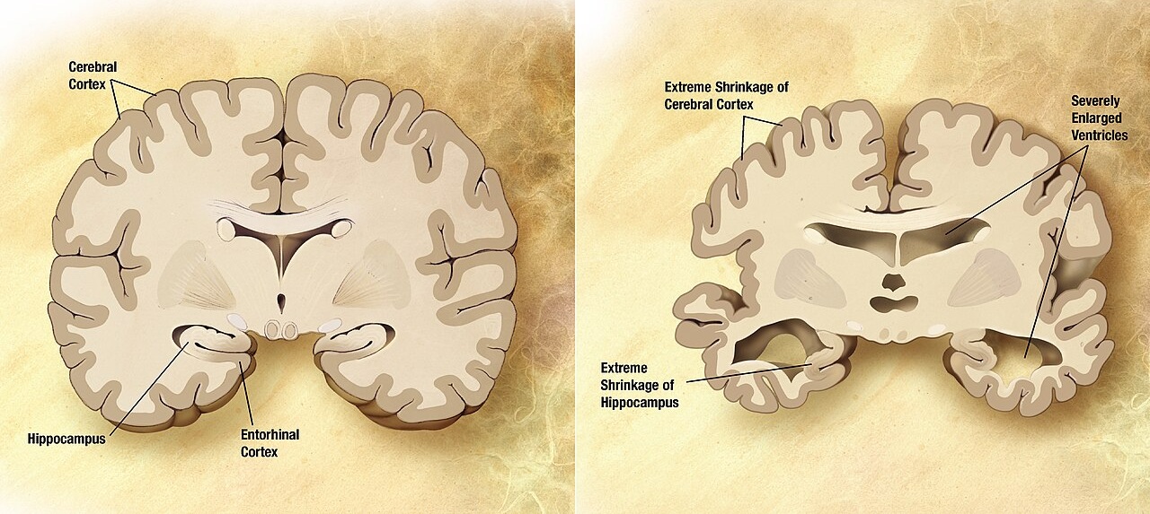 Cerveau normal personne âgée et cerveau Alzheimer
